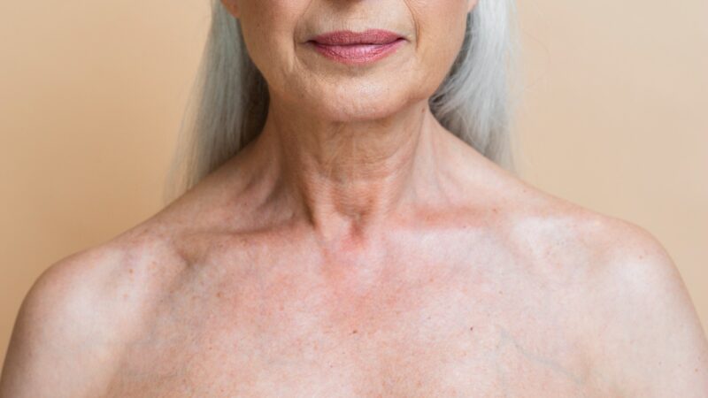 Rugas no colo: entenda as “sleep lines” e como tratá-las